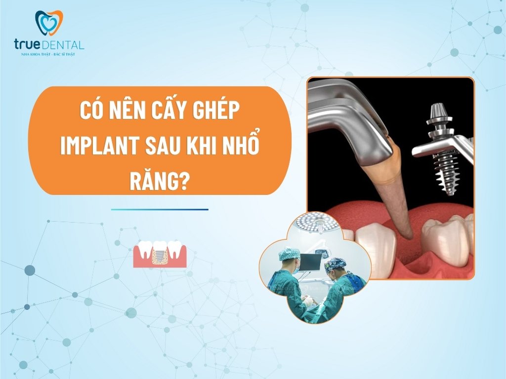 Có nên cấy ghép Implant sau khi nhổ răng?