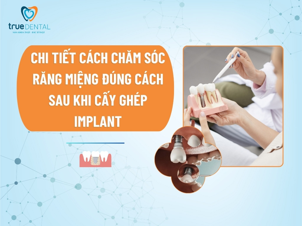 Chi tiết cách chăm sóc răng miệng đúng cách sau khi cấy ghép Implant