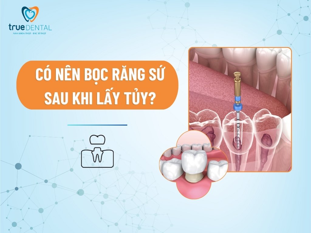 Có nên bọc răng sứ sau khi lấy tủy?