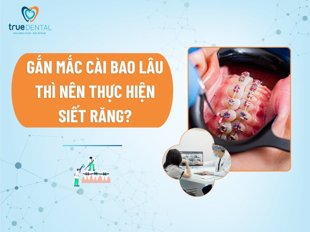 Gắn mắc cài bao lâu thì nên thực hiện siết răng?