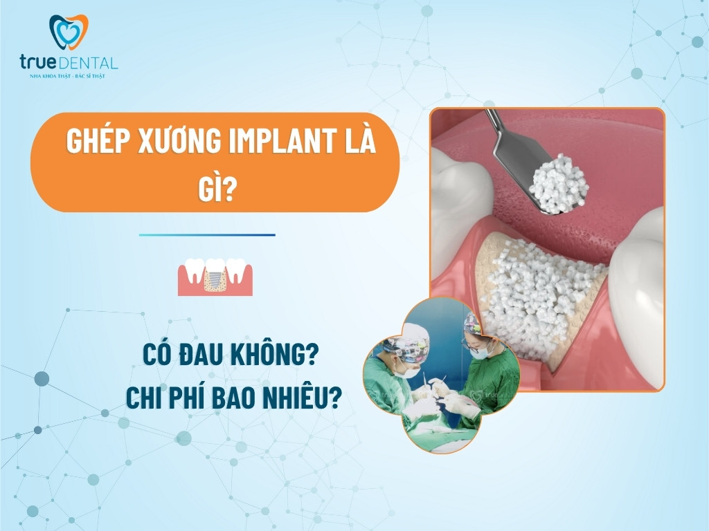 Ghép Xương Implant Là Gì? Có Đau Không? Chi Phí Bao Nhiêu?