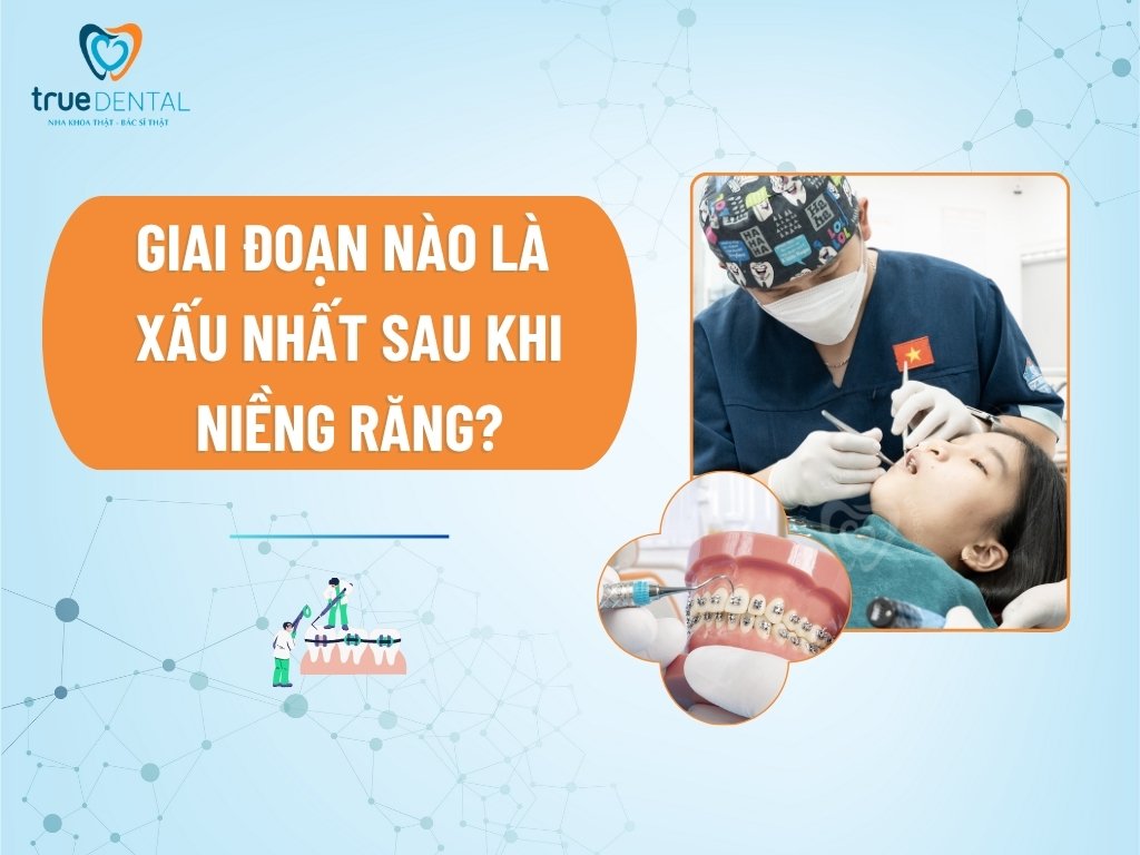 Giai đoạn nào là xấu nhất sau khi niềng răng?