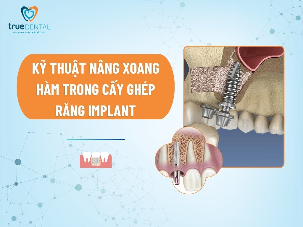 Kỹ thuật nâng xoang hàm trong cấy ghép răng Implant