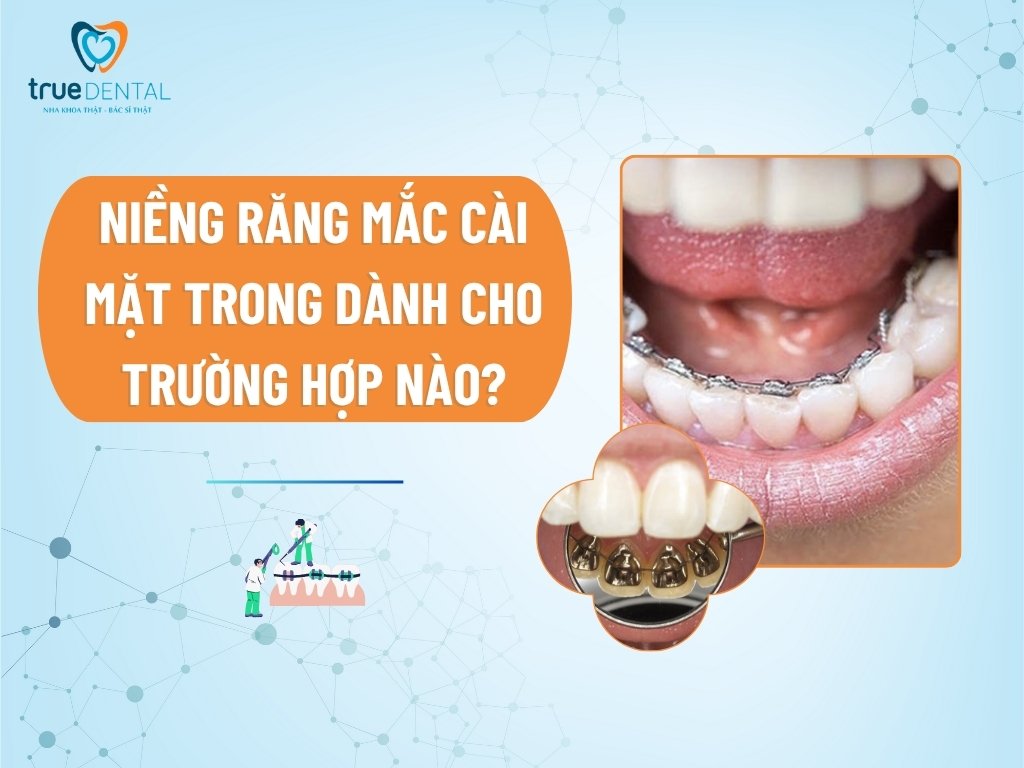Niềng răng mắc cài mặt trong dành cho trường hợp nào?