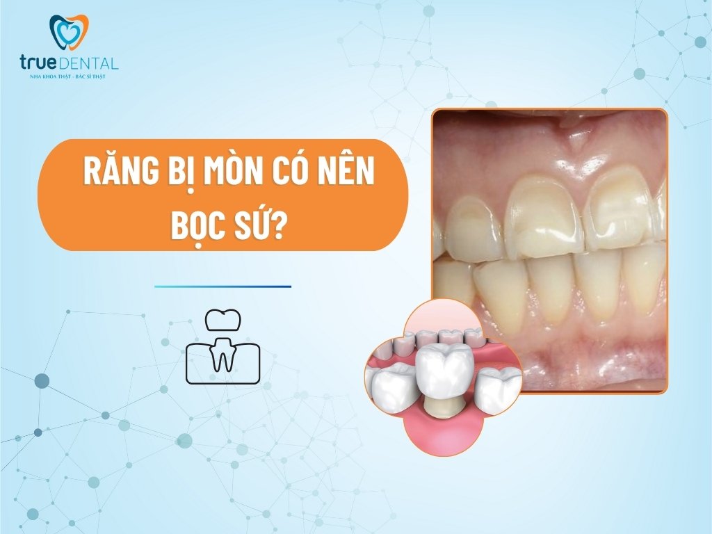 Răng bị mòn có nên bọc sứ? 2 Răng bị mòn có nên bọc sứ?