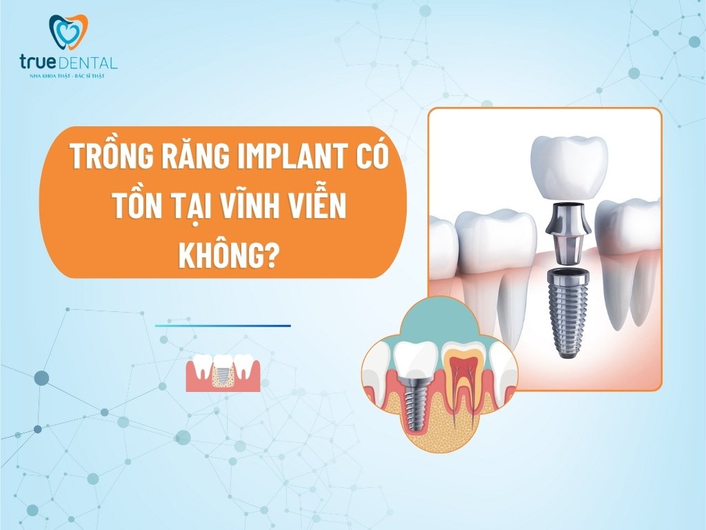 Trồng răng Implant có tồn tại vĩnh viễn không?