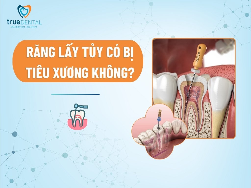Răng lấy tủy có bị tiêu xương không?
