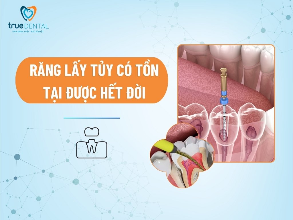 Răng lấy tủy có tồn tại được hết đời