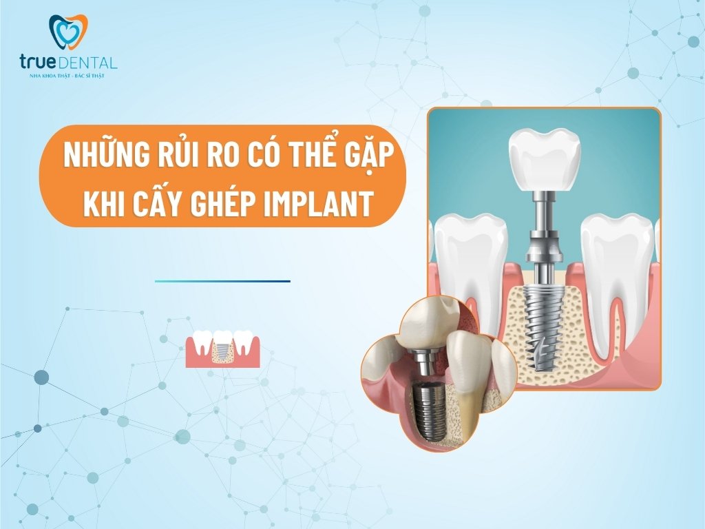 Những rủi ro có thể gặp khi cấy ghép Implant