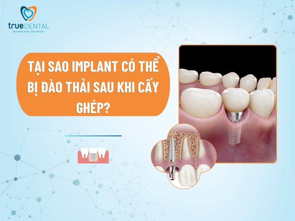 Tại sao Implant có thể bị đào thải