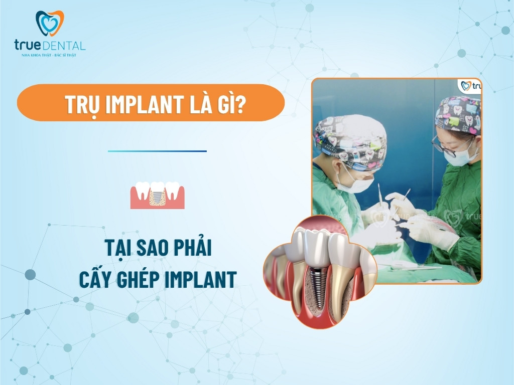 Trụ Implant là gì? Tại sao phải cấy ghép Implant