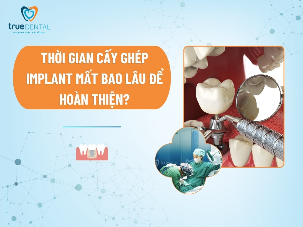 Thời gian cấy ghép Implant mất bao lâu để hoàn thiện?