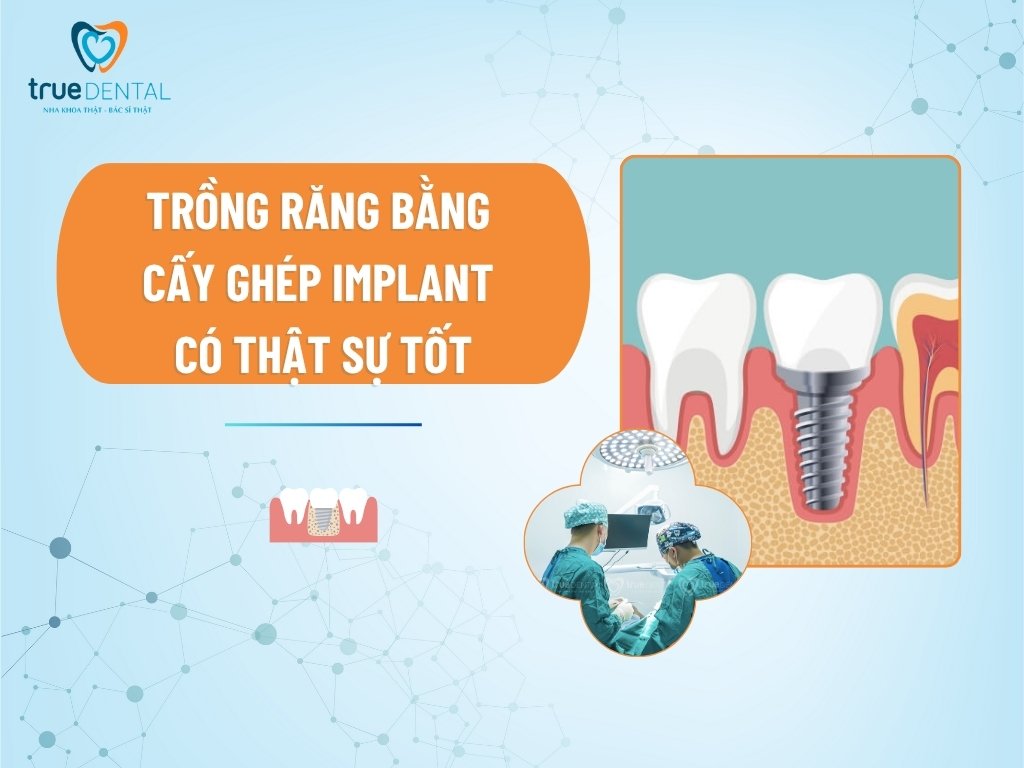 Trồng răng bằng cấy ghép implant có thật sự tốt