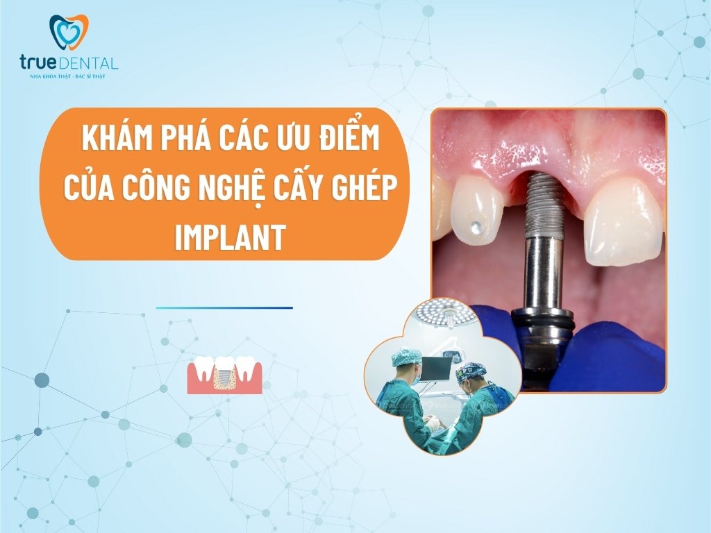 Khám phá các ưu điểm của công nghệ cấy ghép Implant