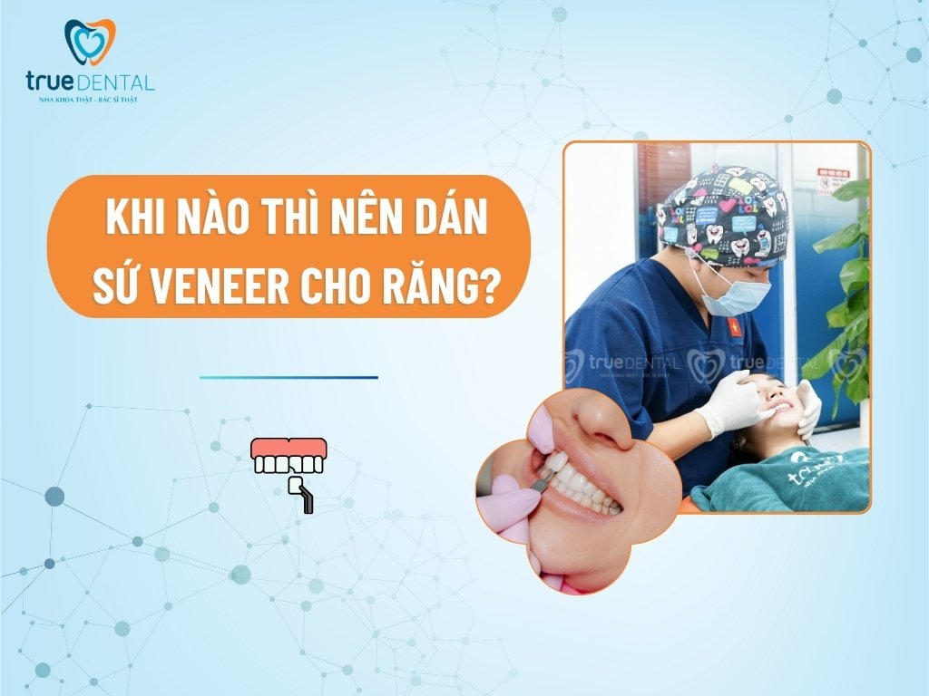 Khi nào thì nên dán sứ Veneer cho răng?