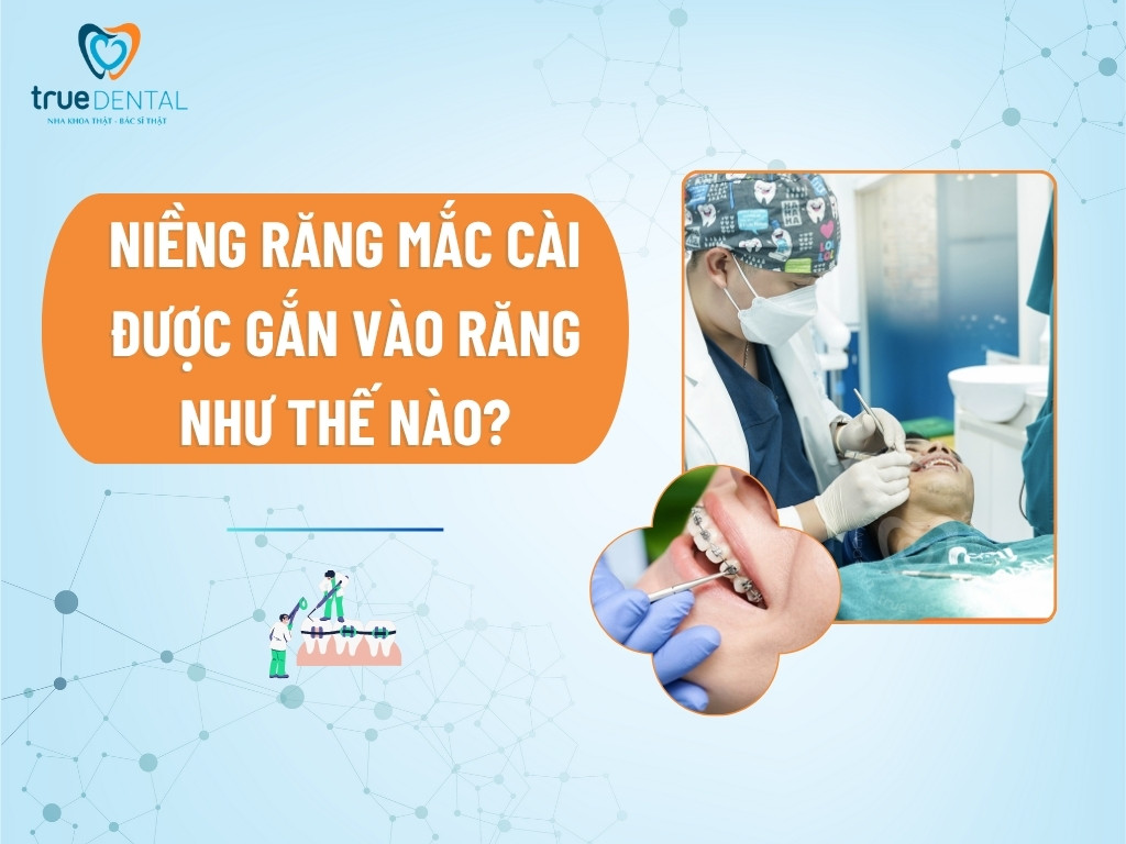 Niềng răng mắc cài được gắn vào răng như thế nào?