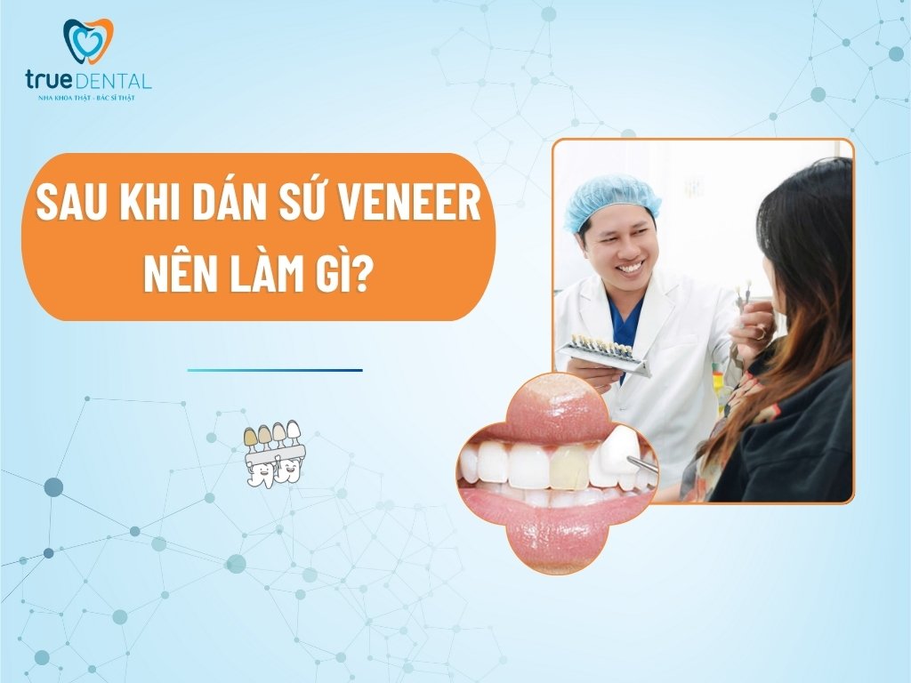 Sau khi dán sứ veneer nên làm gì? 1 Sau khi dán sứ veneer nên làm gì?