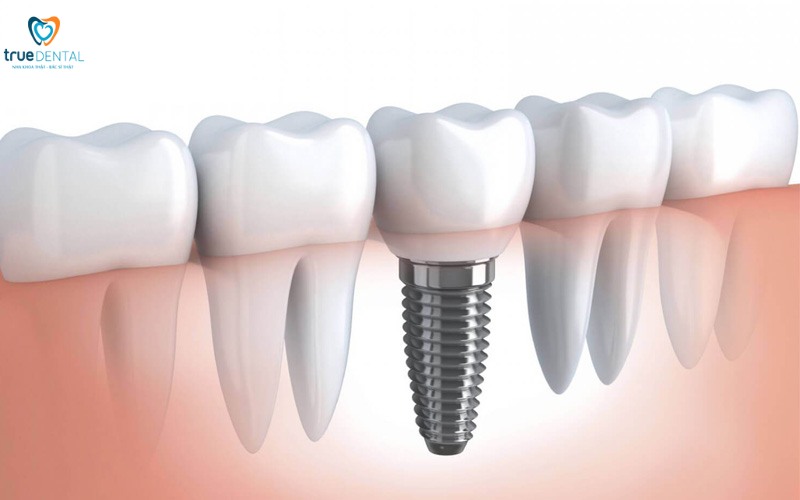 Cấy ghép implant có ảnh hưởng đến giọng nói không