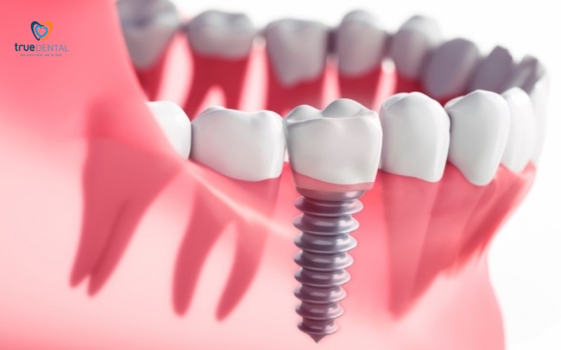Lợi ích cấy ghép implant cho sức khỏe tổng thể