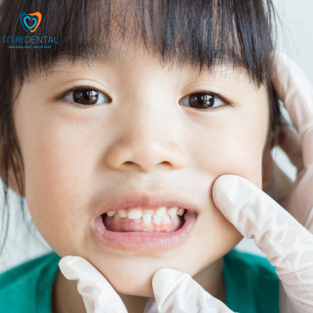 Lợi ích khám răng sớm cho trẻ em