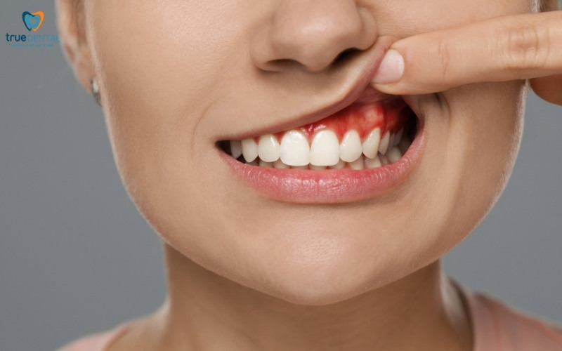 Rủi ro hôi miệng do viêm nướu