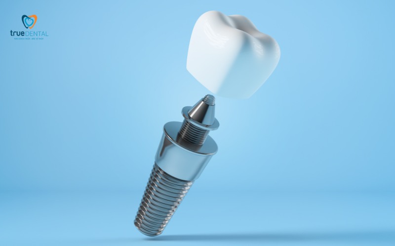 So sánh cấy ghép implant và cầu răng sứ