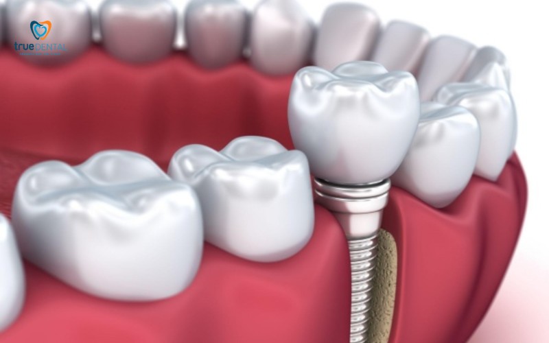 Thời gian bảo hành trụ implant