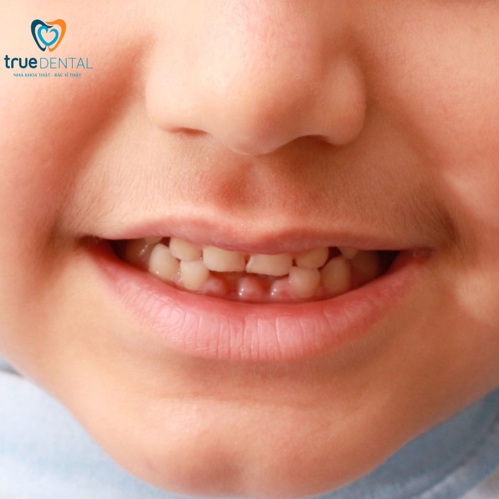 Thời gian khám răng cho trẻ nhỏ - Hướng dẫn chi tiết từ chuyên gia True Dental 14 Thời gian khám răng cho trẻ nhỏ