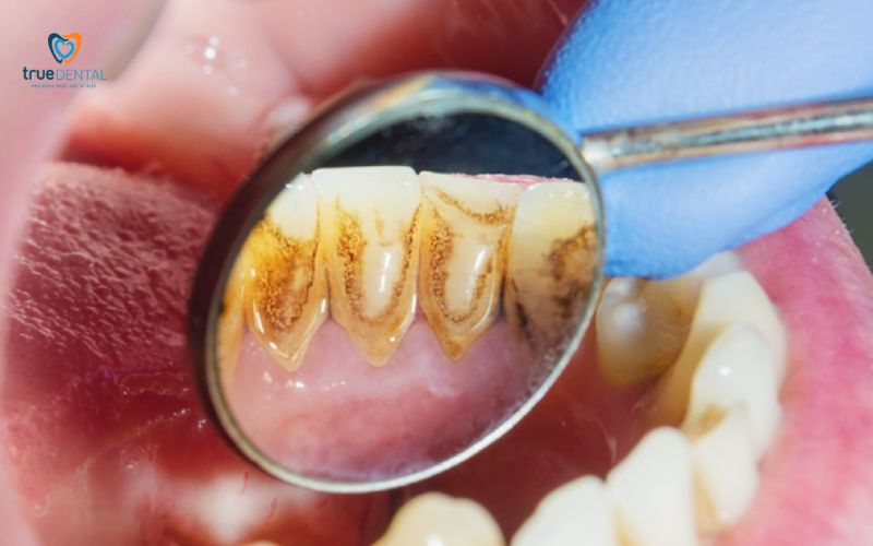 Thời gian lành sau cạo vôi răng