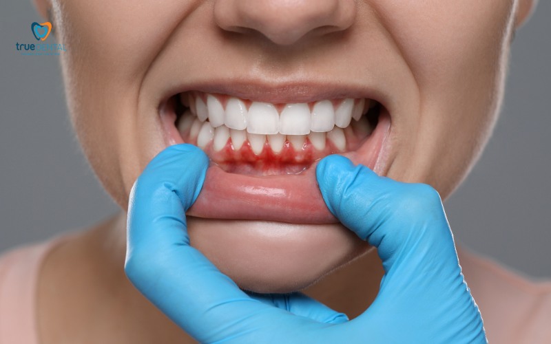 chi phí điều trị viêm lợi tại TP.HCM