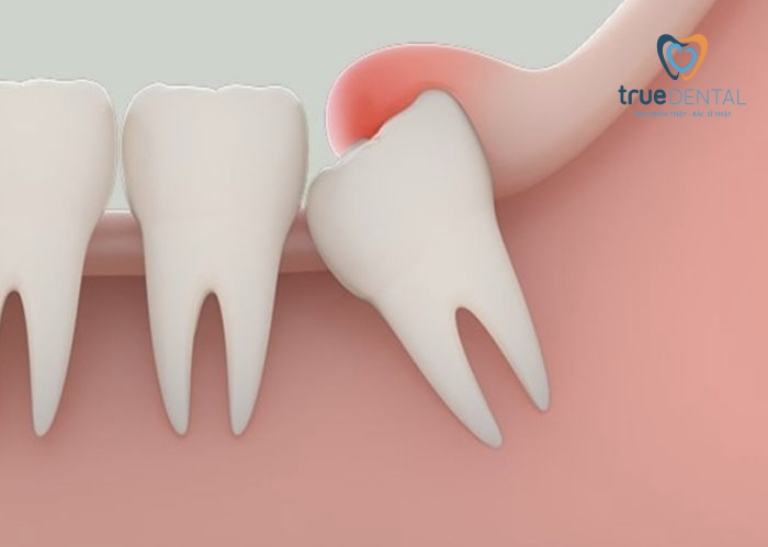 so sánh nhổ răng thường và khôn