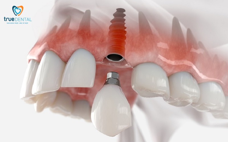 Cách chọn kích thước trụ implant phù hợp