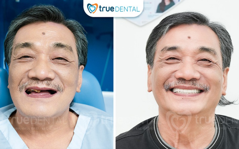 Cấy ghép implant cho răng hàm trên