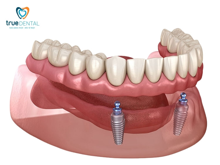 Cấy ghép implant hybrid là gì