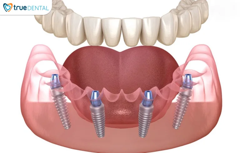 Chi phí cấy ghép implant cho hàm răng khuyết