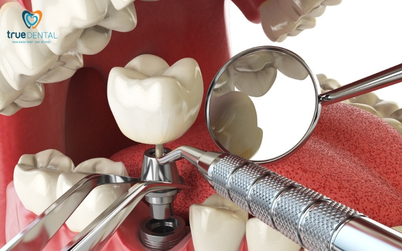 Chi phí cấy ghép implant tức thì tại Sài Gòn