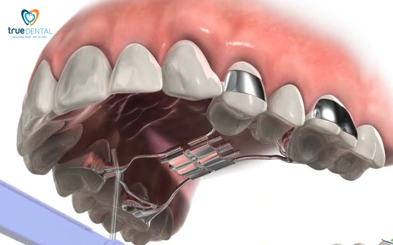 Chi phí niềng răng expander tại TP.HCM
