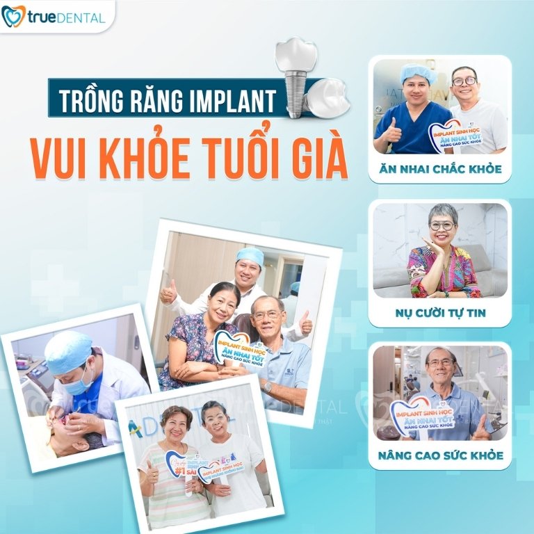 Lợi ích cấy ghép implant cho người trung niên