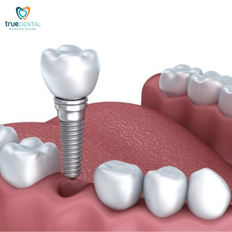 Lợi ích cấy ghép implant lâu dài