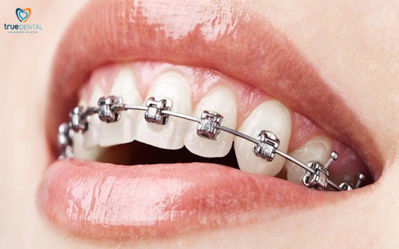 Lợi ích niềng răng cho sức khỏe răng miệng