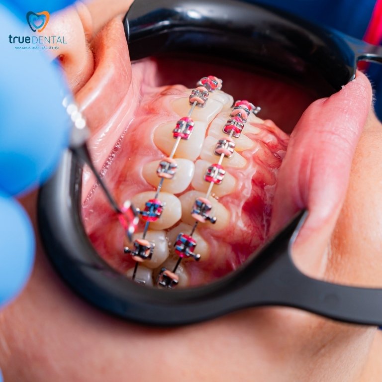 Niềng răng có ảnh hưởng đến ăn uống không