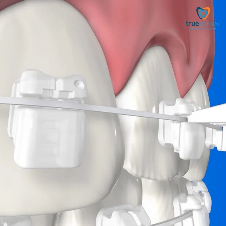 Niềng răng mắc cài ceramic