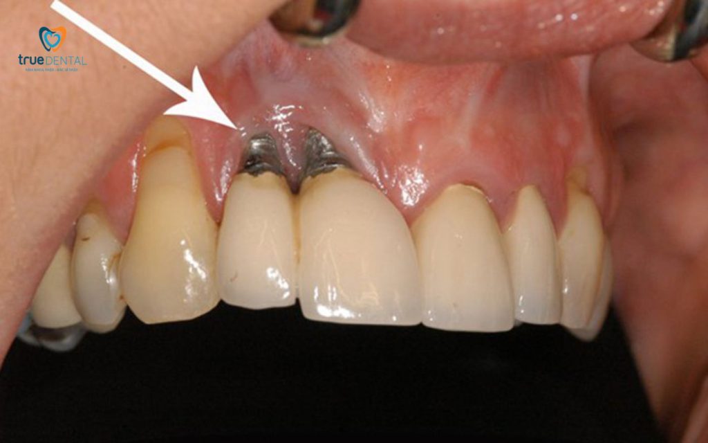 Rủi ro dị ứng với trụ implant