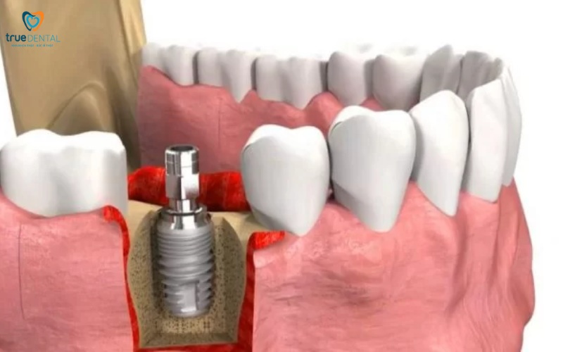 Rủi ro trụ implant bị gãy