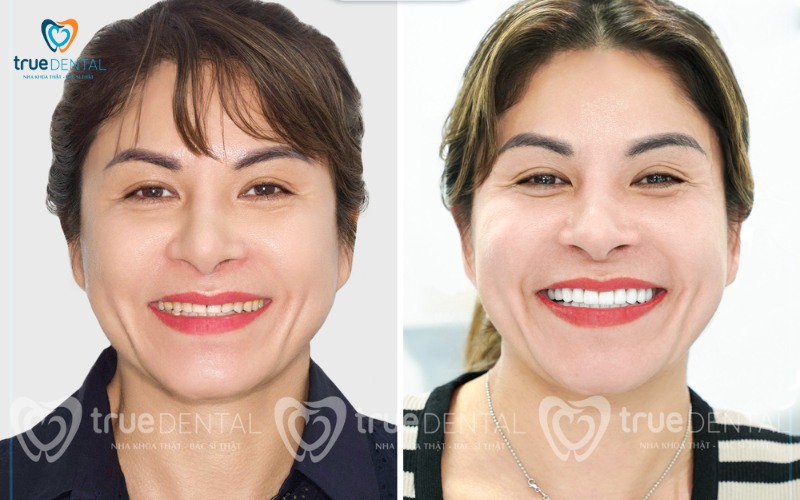 So sánh bọc răng sứ và implant