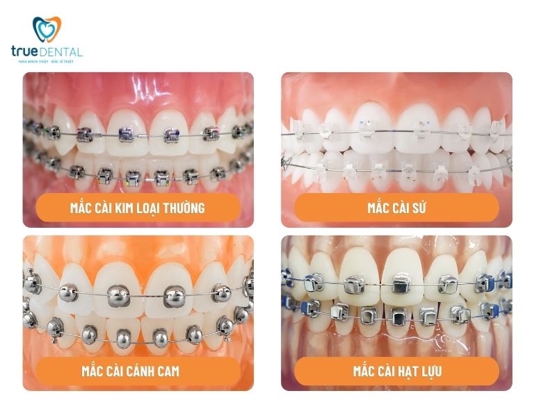 Thời gian bảo hành niềng răng