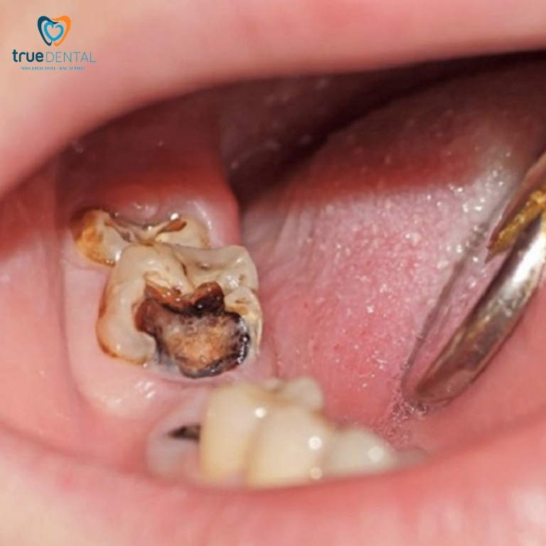 Rủi ro niềng răng bị sâu răng
