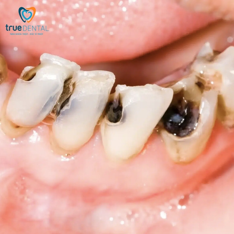 Rủi ro sâu răng ở người nghiện cà phê