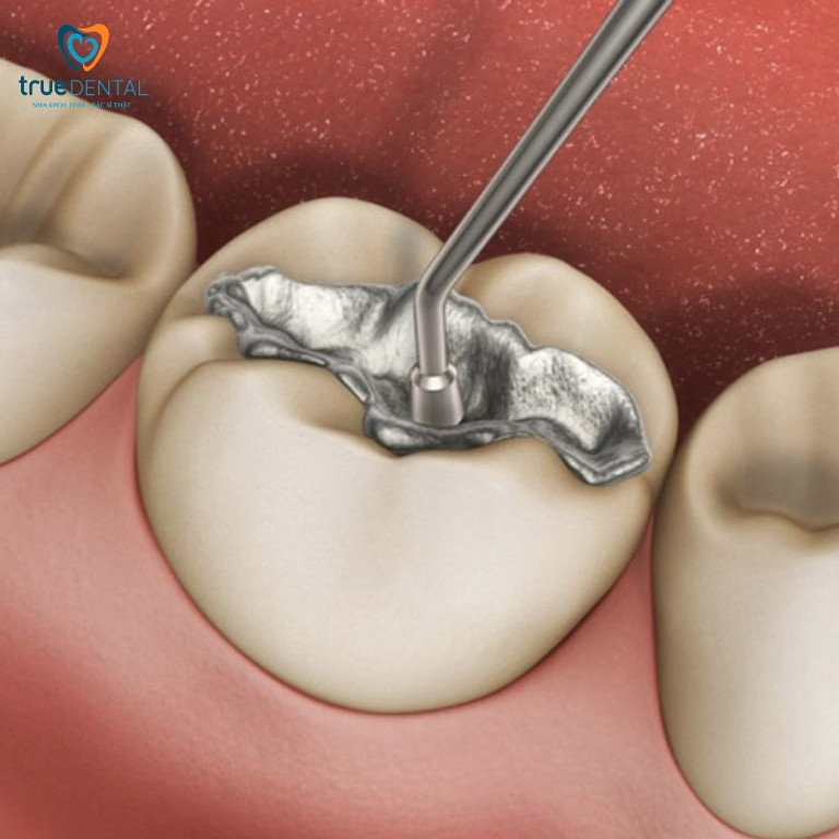 Trám răng tại Quận 3 giá bao nhiêu