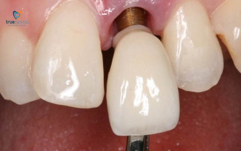 True Dental cam kết gì khi cấy implant